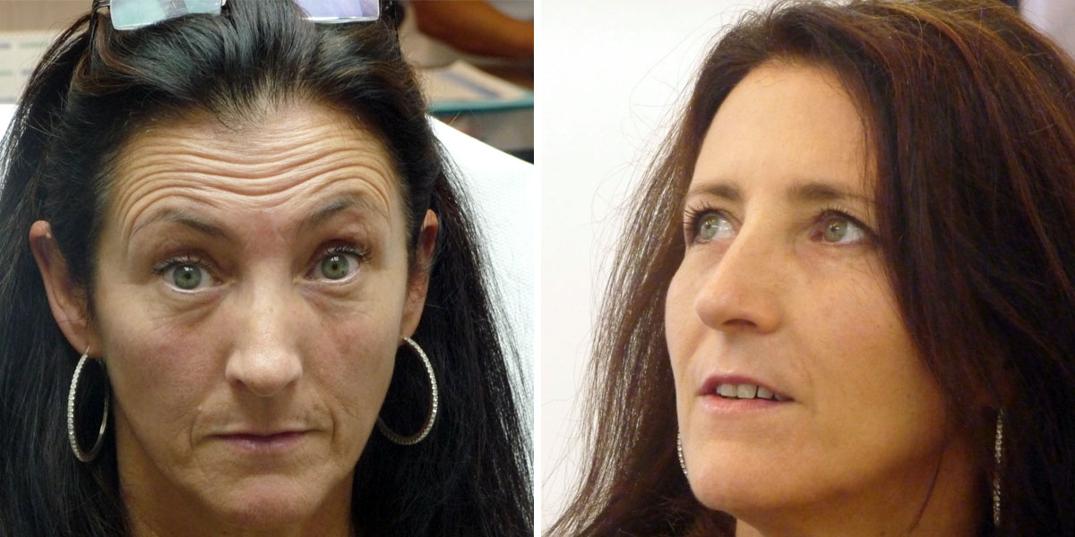 Photo avant et après de lissage du front en médecine esthétique
