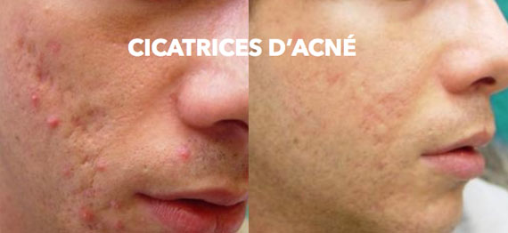 Cicatrice d'acné