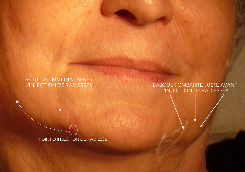 Comparaison effet liftant immédiat de l'injection de Radiesse