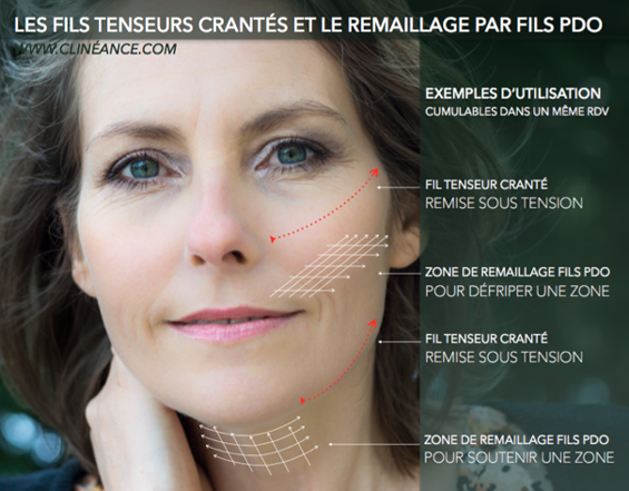 Les applications des fils tenseurs pour le rajeunissement du visage