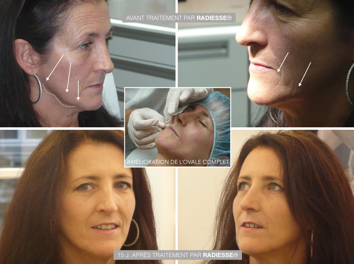 Lifting du visage par injections de Radiesse