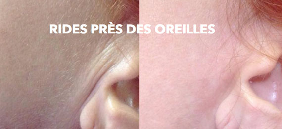 Traitement des rides des oreilles